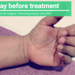 Carpal Tunnel syndrom Progress Video