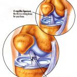 Knee ligament ACL tear