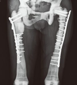 Thigh bone fracture surgery recovery